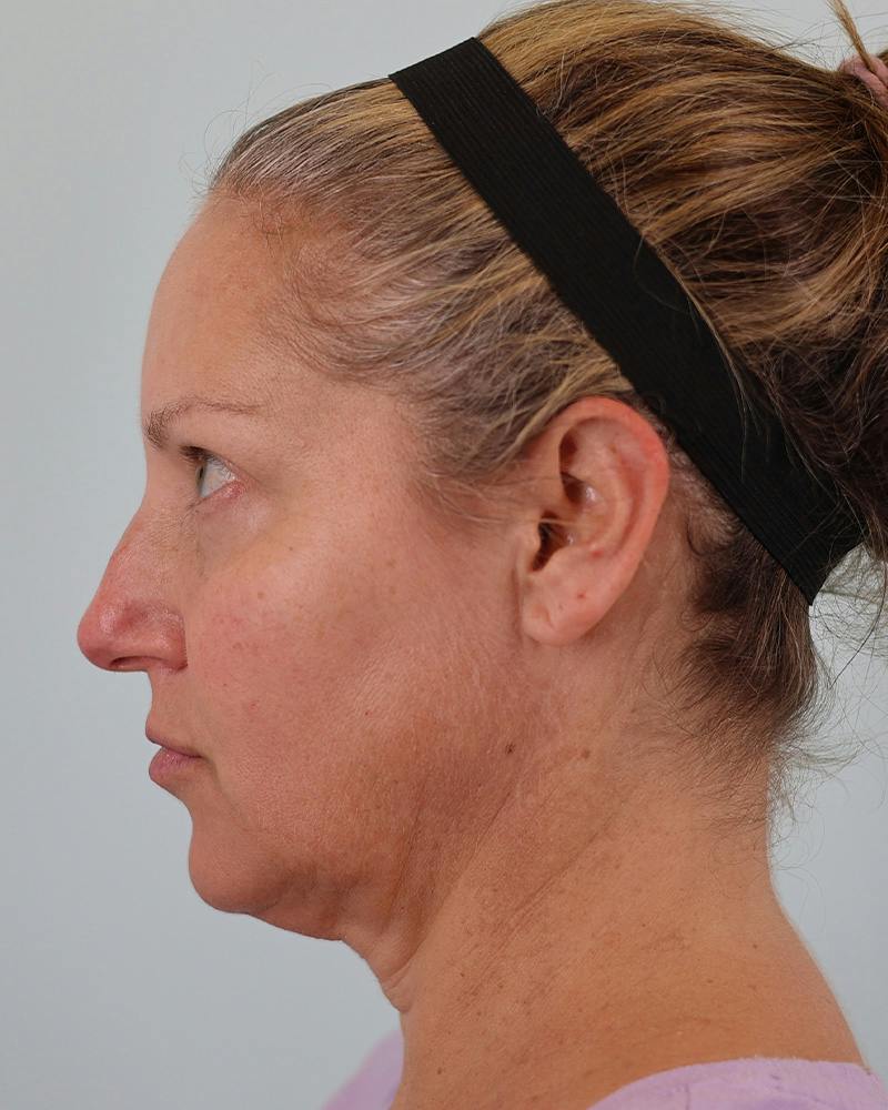Facial Fat Transfer Before & After Gallery - Patient 103564 - Image 11