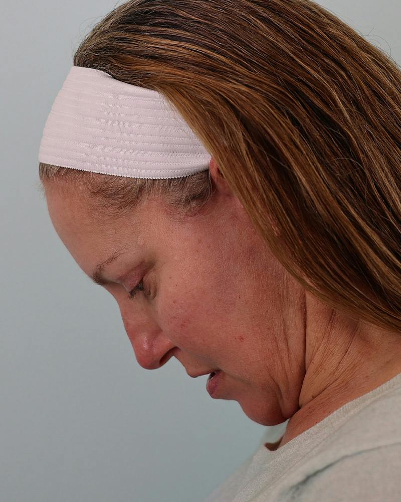 Facial Fat Transfer Before & After Gallery - Patient 103564 - Image 14
