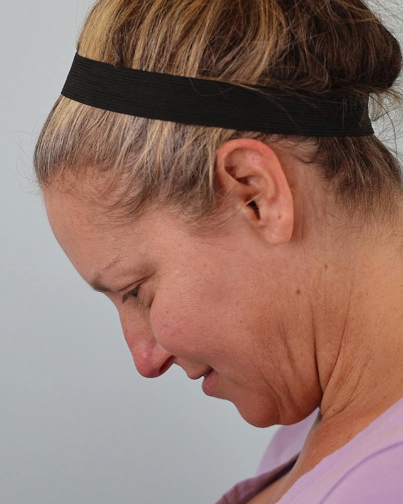 Facial Fat Transfer Before & After Gallery - Patient 103564 - Image 13