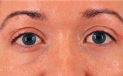 Ptosis Correction Before & After Gallery - Patient 344091 - Image 2