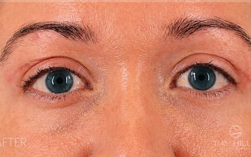 Winged Blepharoplasty Before & After Gallery - Patient 408007 - Image 2