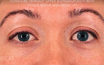 Ptosis Correction Before & After Gallery - Patient 344091 - Image 1