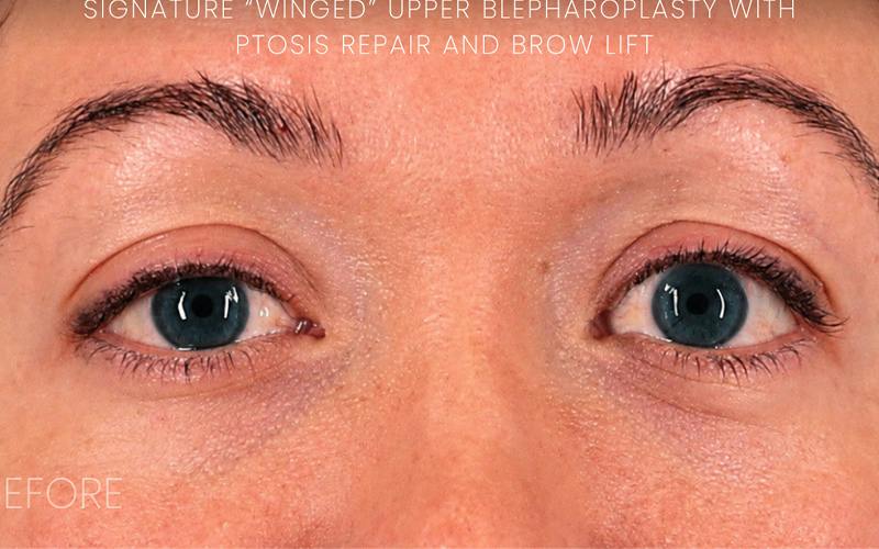Winged Blepharoplasty Before & After Gallery - Patient 408007 - Image 1