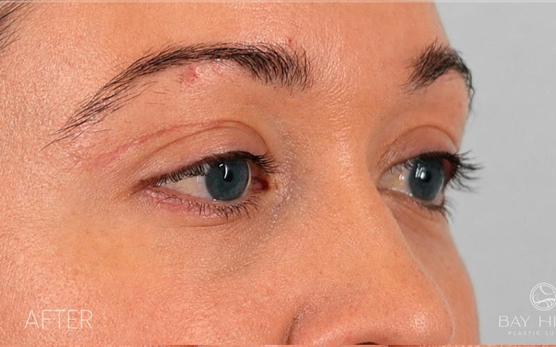 Winged Blepharoplasty Before & After Gallery - Patient 408007 - Image 4