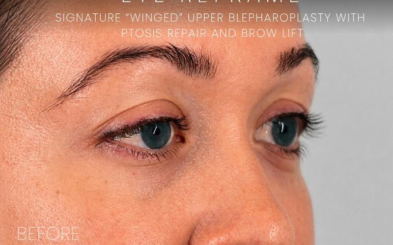 Winged Blepharoplasty Before & After Gallery - Patient 408007 - Image 3