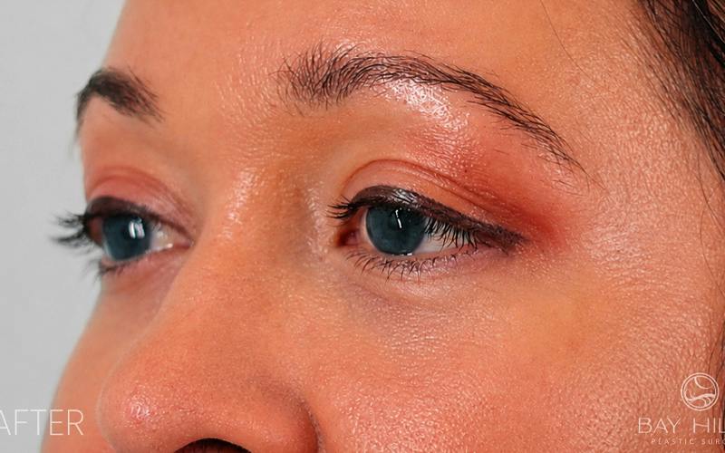 Winged Blepharoplasty Before & After Gallery - Patient 408007 - Image 6