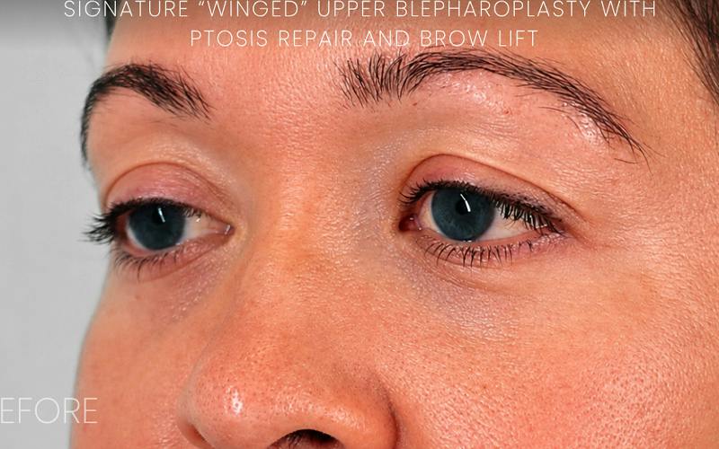 Winged Blepharoplasty Before & After Gallery - Patient 408007 - Image 5