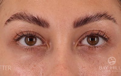 Lower Blepharoplasty Before & After Gallery - Patient 214396 - Image 2