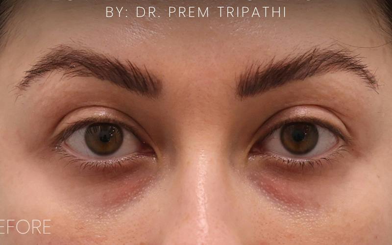 Lower Blepharoplasty Before & After Gallery - Patient 214396 - Image 1