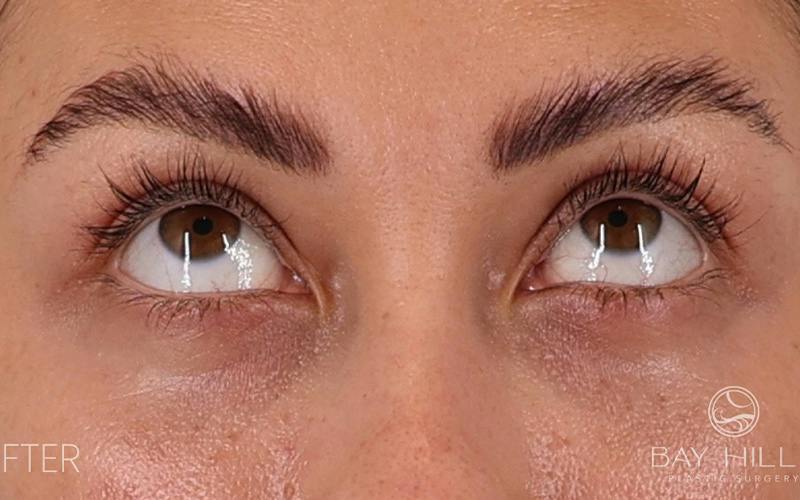 Lower Blepharoplasty Before & After Gallery - Patient 214396 - Image 6