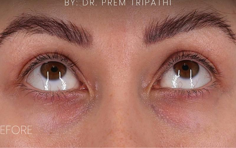 Lower Blepharoplasty Before & After Gallery - Patient 214396 - Image 5