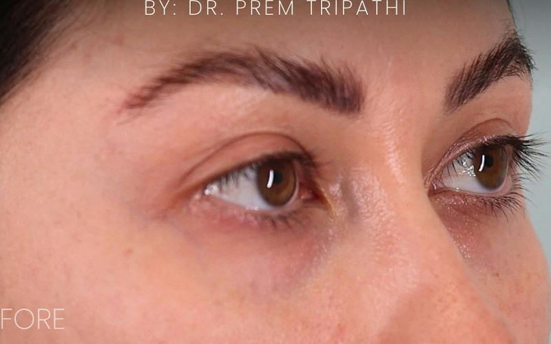 Lower Blepharoplasty Before & After Gallery - Patient 214396 - Image 3