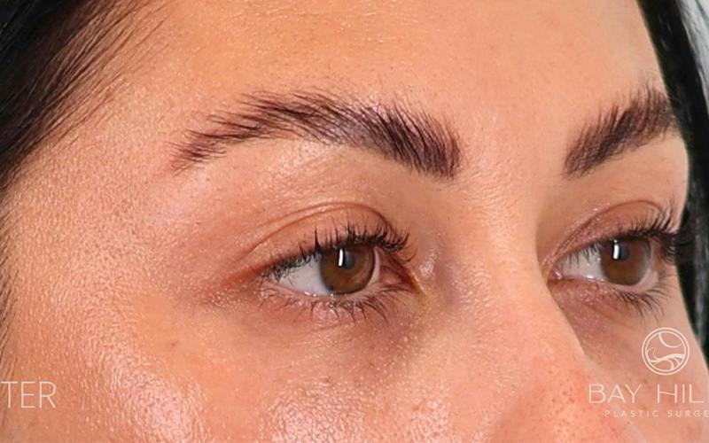 Lower Blepharoplasty Before & After Gallery - Patient 214396 - Image 4