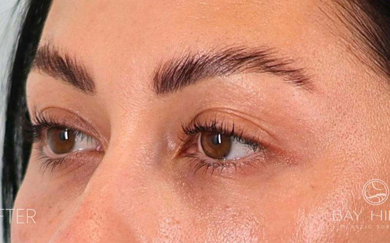 Lower Blepharoplasty Before & After Gallery - Patient 214396 - Image 8