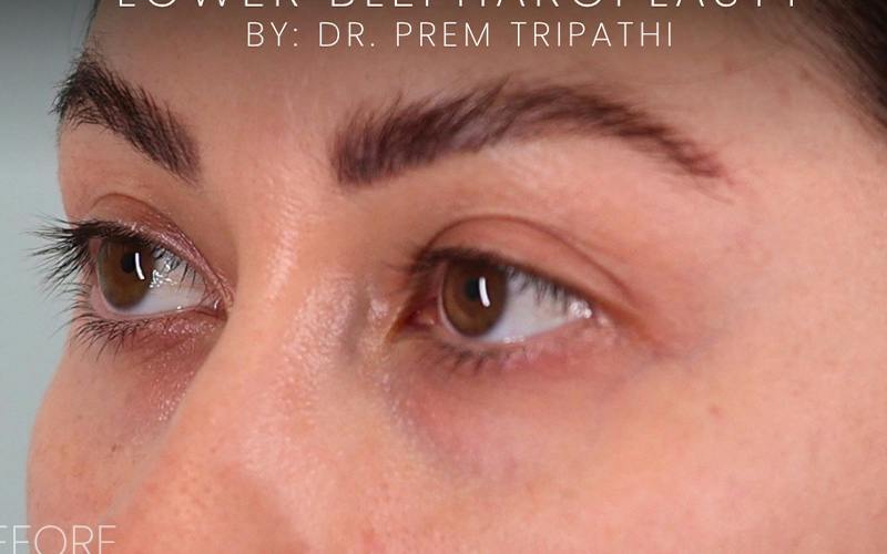 Lower Blepharoplasty Before & After Gallery - Patient 214396 - Image 7