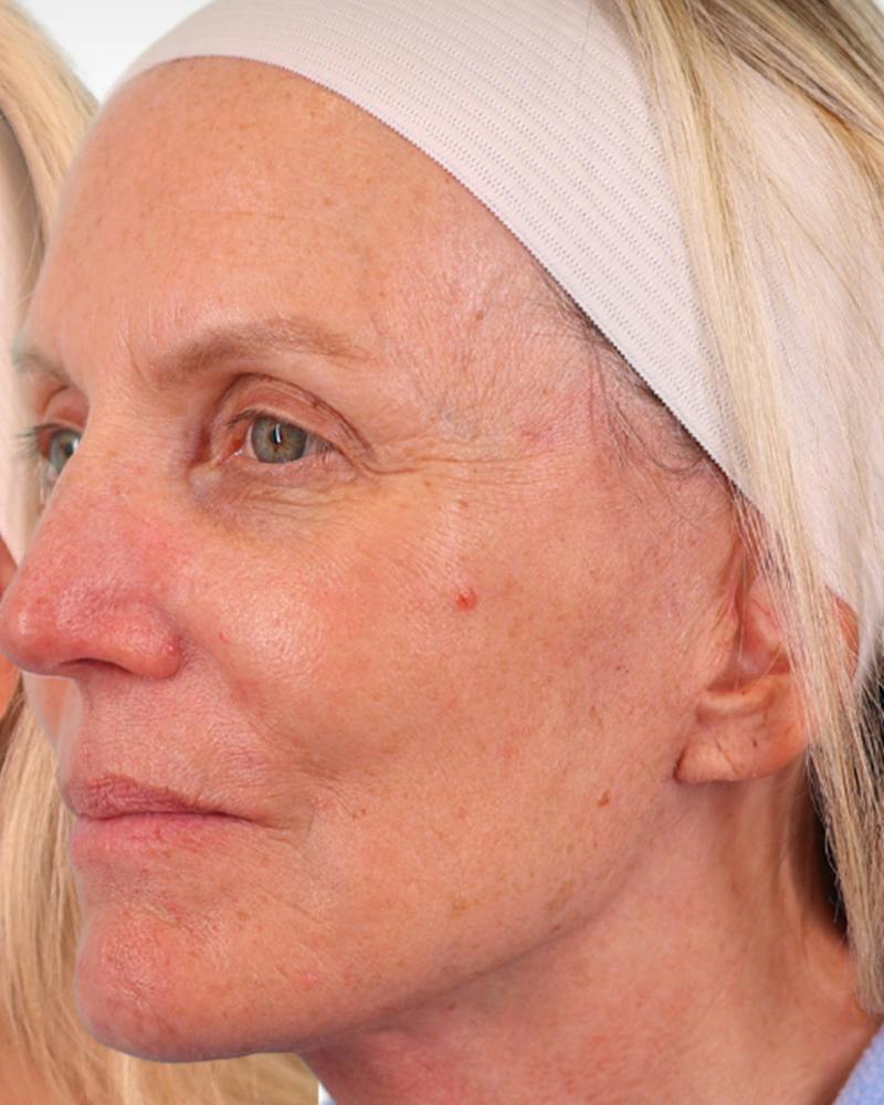 Facelift Before & After Gallery - Patient 303566 - Image 8