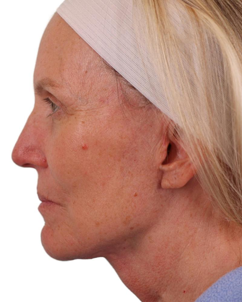 Facelift Before & After Gallery - Patient 303566 - Image 10