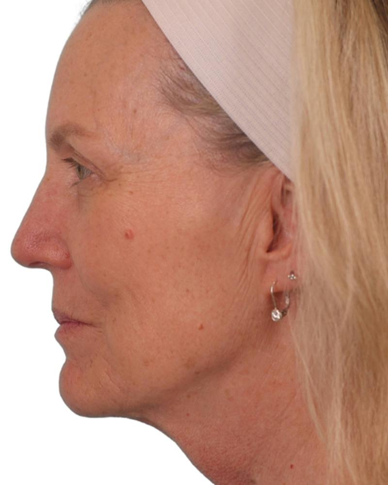 Facelift Before & After Gallery - Patient 303566 - Image 9