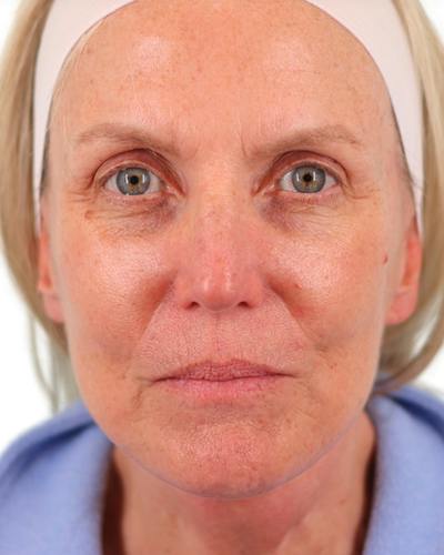 Facelift Before & After Gallery - Patient 303566 - Image 2