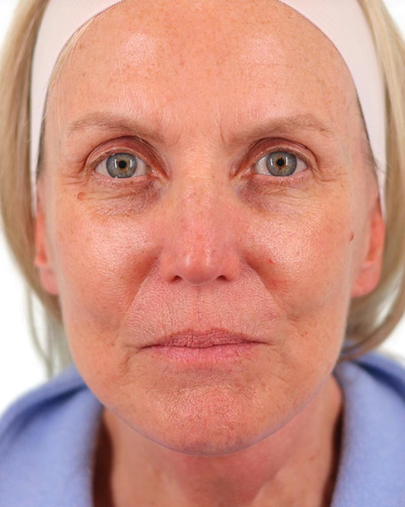 Facelift Before & After Gallery - Patient 303566 - Image 2