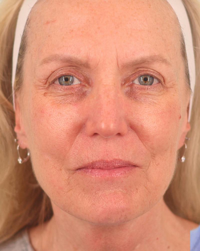Facelift Before & After Gallery - Patient 303566 - Image 1