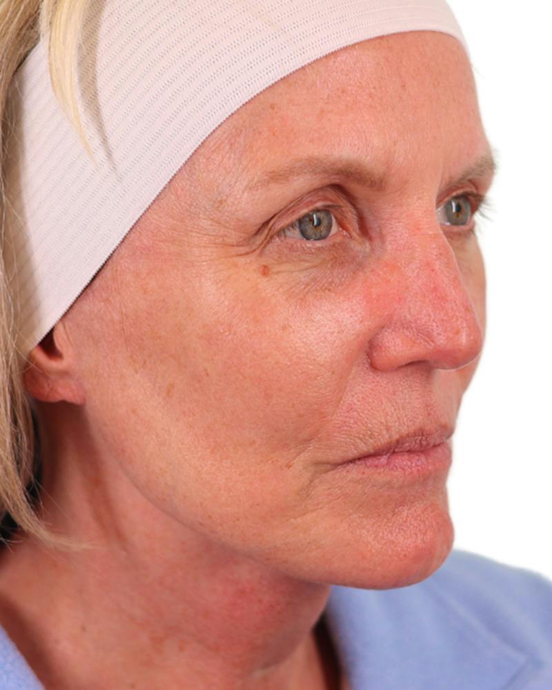 Facelift Before & After Gallery - Patient 303566 - Image 4