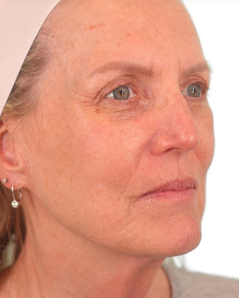 Facelift Before & After Gallery - Patient 303566 - Image 3