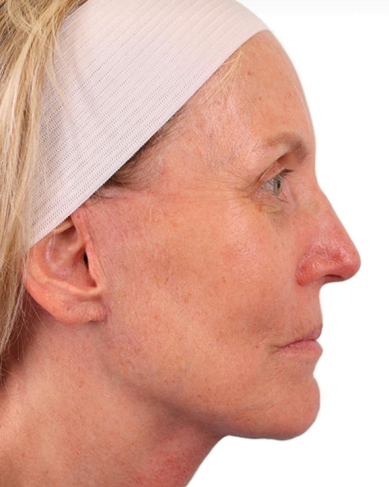Facelift Before & After Gallery - Patient 303566 - Image 6