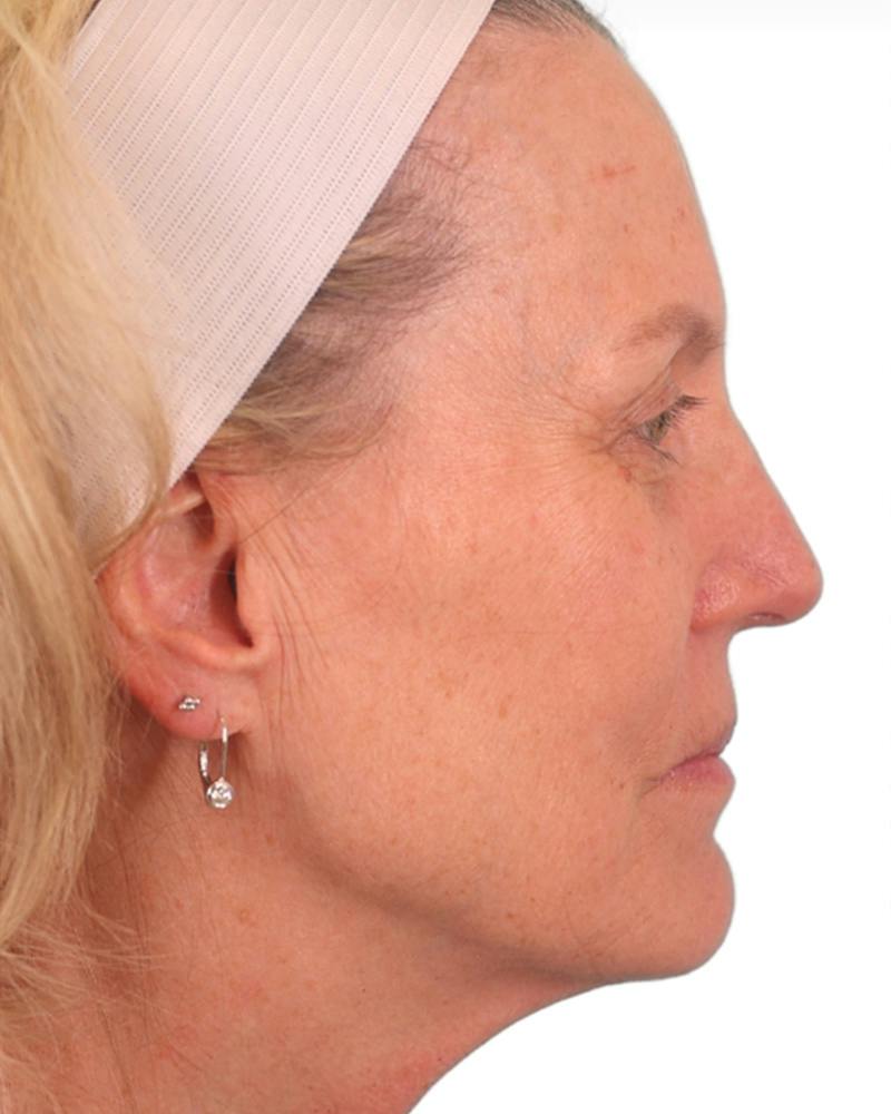 Facelift Before & After Gallery - Patient 303566 - Image 5