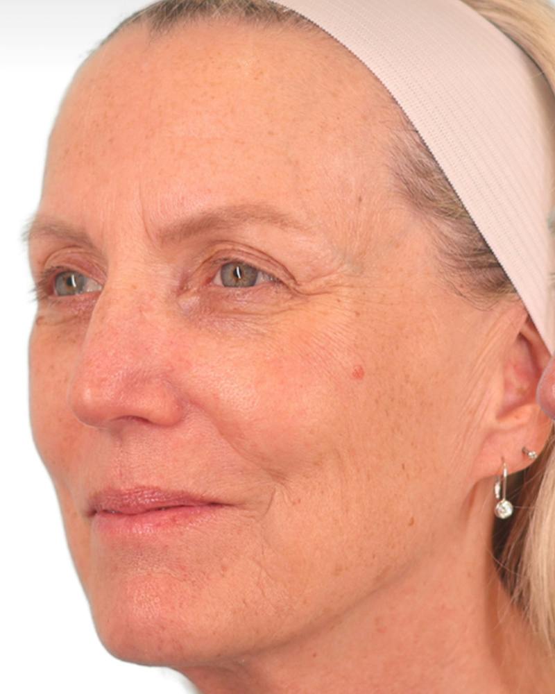 Facelift Before & After Gallery - Patient 303566 - Image 7
