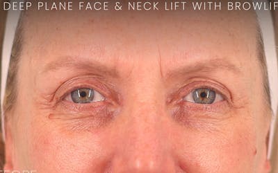 Brow Lift Before & After Gallery - Patient 103935 - Image 1