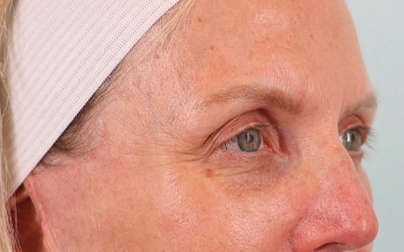 Brow Lift Before & After Gallery - Patient 103935 - Image 4