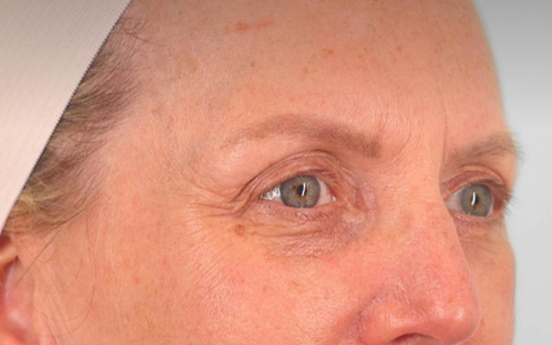 Brow Lift Before & After Gallery - Patient 103935 - Image 3