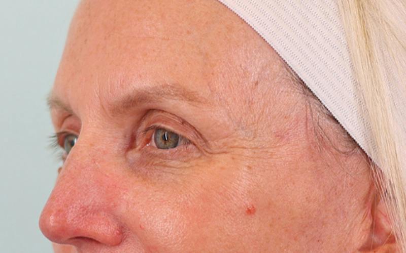 Brow Lift Before & After Gallery - Patient 103935 - Image 5