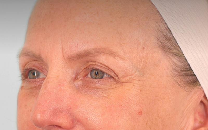 Brow Lift Before & After Gallery - Patient 103935 - Image 6