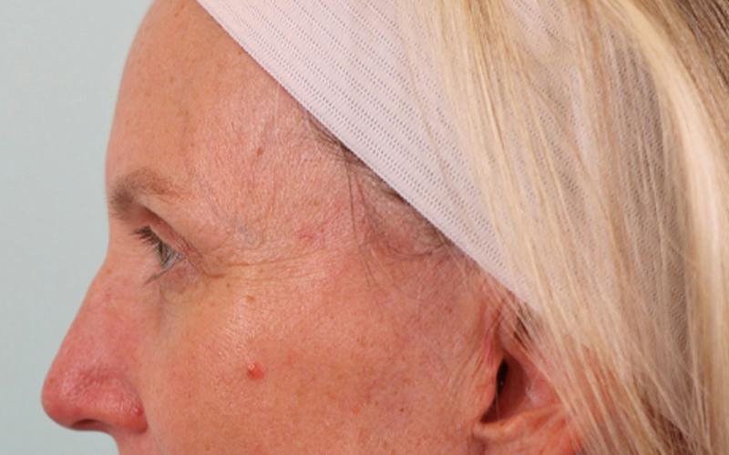 Brow Lift Before & After Gallery - Patient 103935 - Image 8