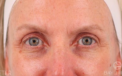 Brow Lift Before & After Gallery - Patient 103935 - Image 2