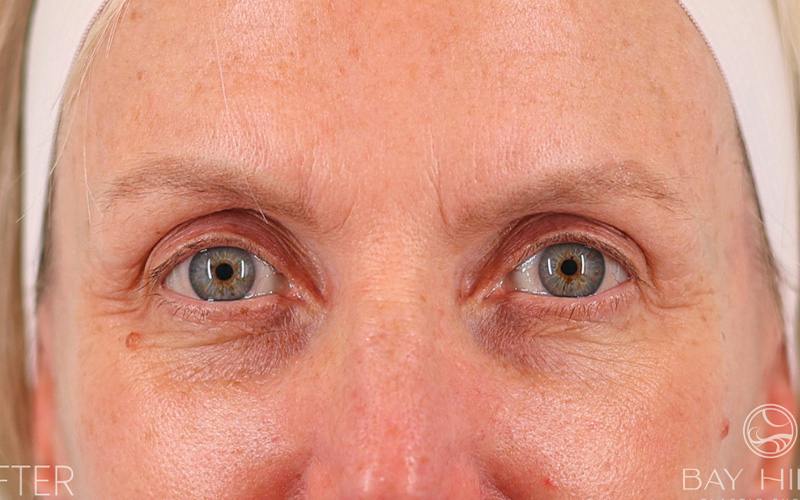 Brow Lift Before & After Gallery - Patient 103935 - Image 2