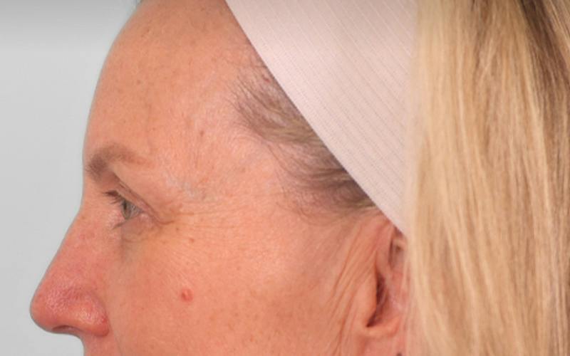 Brow Lift Before & After Gallery - Patient 103935 - Image 7