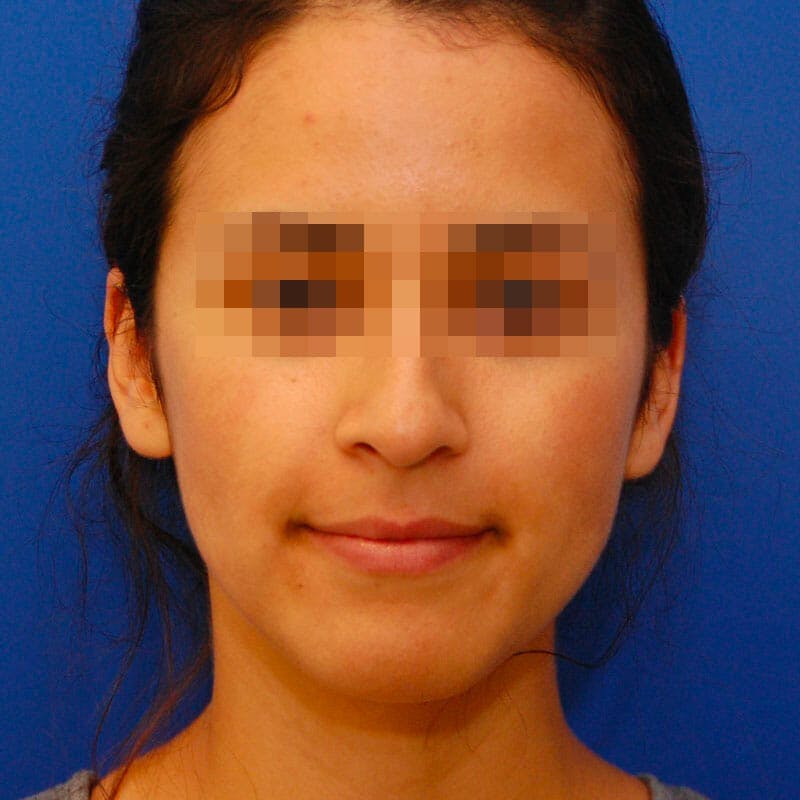 Female Rhinoplasty Before & After Gallery - Patient 168972 - Image 3