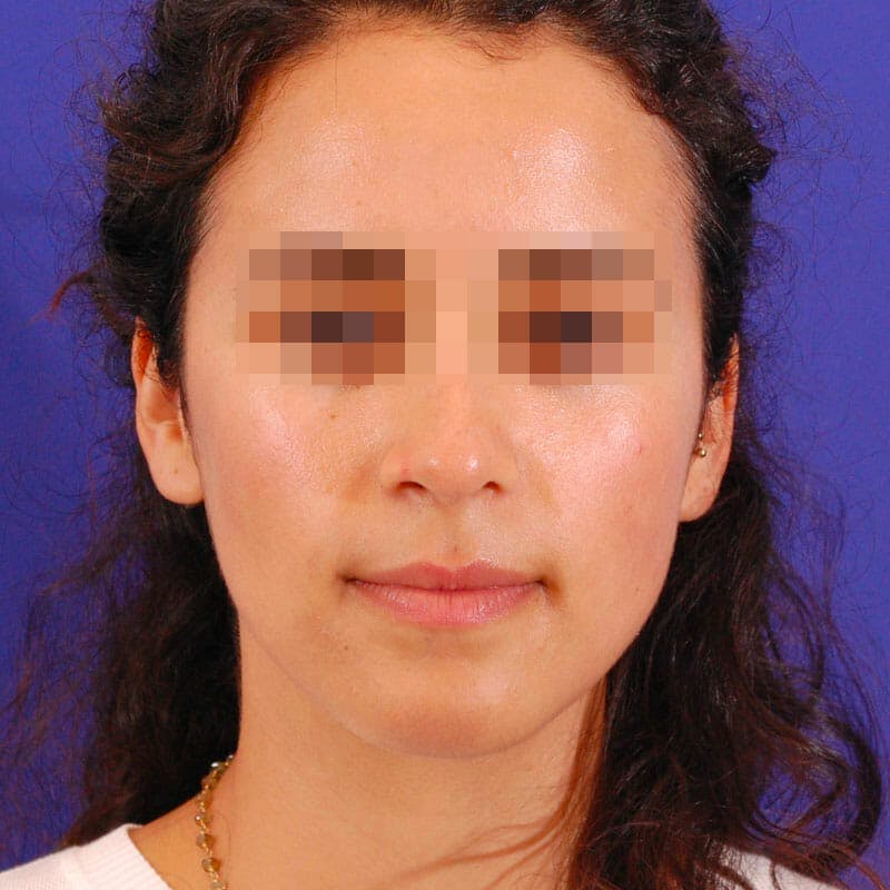 Female Rhinoplasty Before & After Gallery - Patient 168972 - Image 4