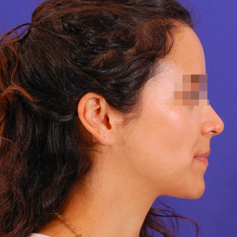 Female Rhinoplasty Before & After Gallery - Patient 168972 - Image 6