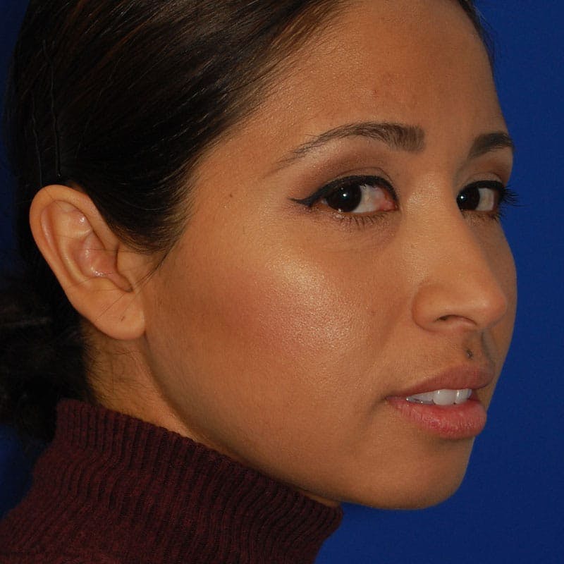 Female Rhinoplasty Before & After Gallery - Patient 205759 - Image 5