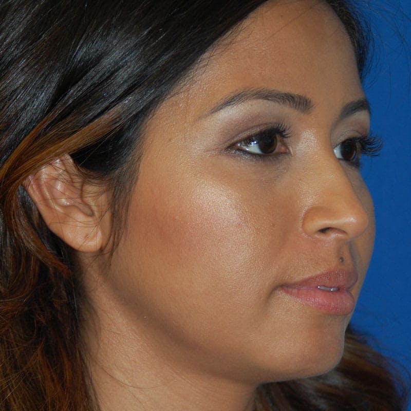 Female Rhinoplasty Before & After Gallery - Patient 205759 - Image 4
