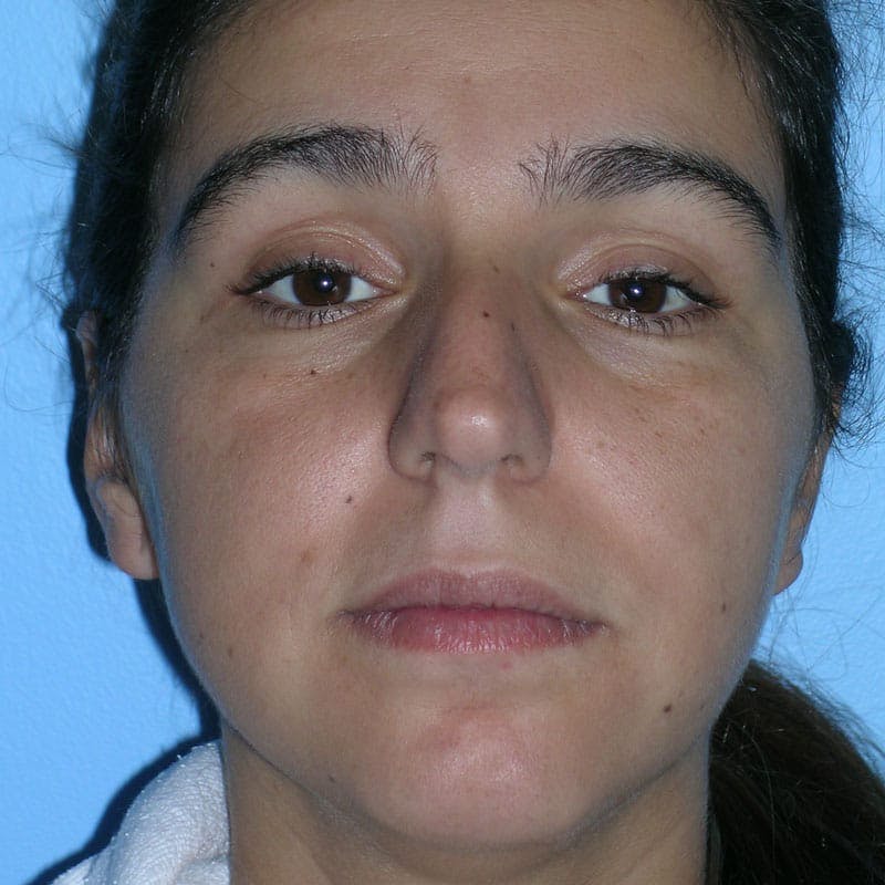 Female Rhinoplasty Before & After Gallery - Patient 272584 - Image 1