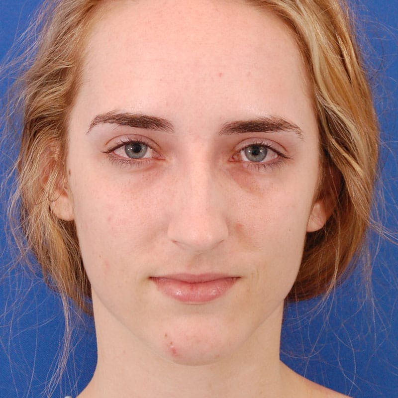 Female Rhinoplasty Before & After Gallery - Patient 290879 - Image 3