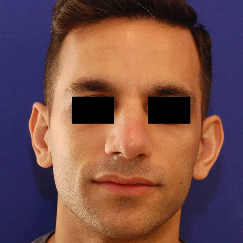 Male Rhinoplasty Before & After Gallery - Patient 308731 - Image 1