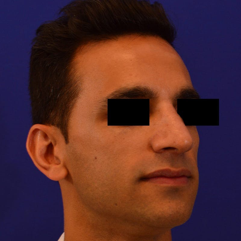 Male Rhinoplasty Before & After Gallery - Patient 308731 - Image 6