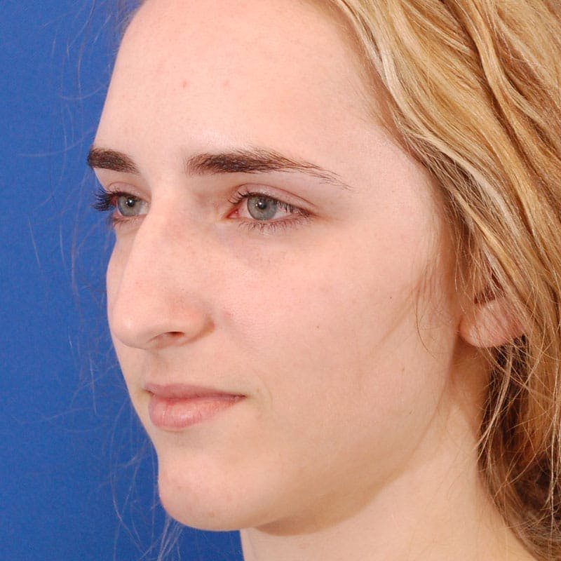 Female Rhinoplasty Before & After Gallery - Patient 290879 - Image 5