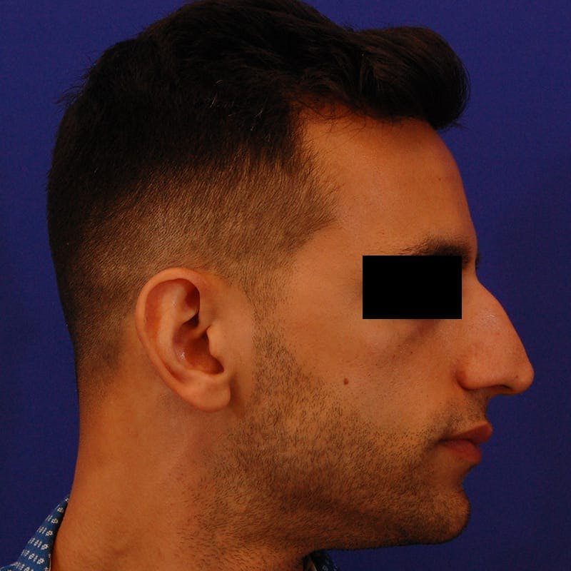 Male Rhinoplasty Before & After Gallery - Patient 308731 - Image 1